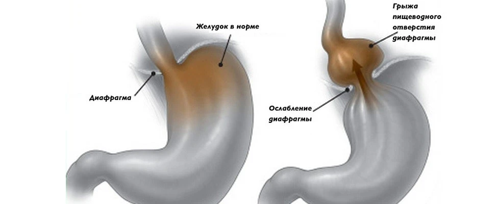 В ПКМЦ ПРООПЕРИРОВАЛИ ДИАФРАГМАЛЬНУЮ ГРЫЖУ